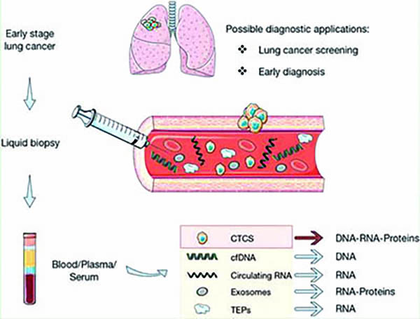 液体活检或有助于识别出放疗获益的NSCLC